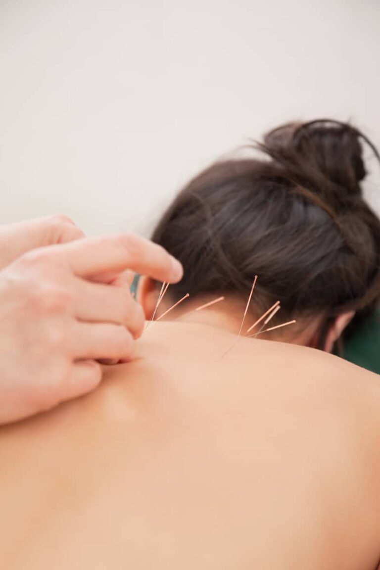 Acupuncture needles on back of a woman at the spa. Ellena West Osteopathy. Osteopathy, local Osteopathy, Osteopathy Treatment, Clinical Pilates, Physio Pilates, Medical Pilates. Saltford, Keynsham.
